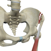 Avulsion Fractures of the Pelvis