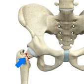 Femoral Neck Fracture