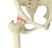 Femoroacetabular Impingement