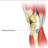 Goosefoot Bursitis of the Knee