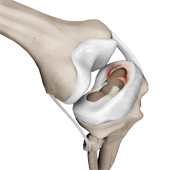 Meniscal Injuries