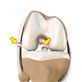 Multiligament Instability