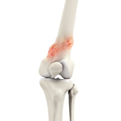 Osteonecrosis of the Knee