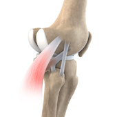 Posterolateral Instability