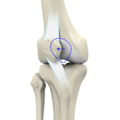 Recurrent Patella Dislocation