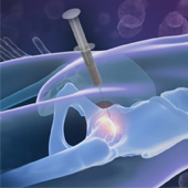 Stem Cell Therapy for Hip Injuries