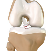 Tibial Eminence Fractures